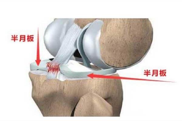 徐梦桃摘金背后:半月板切除70% 半月板损伤怎么造成的