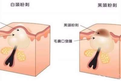 ​毛角周化和闭口的区别 毛角周化和闭口怎么区分