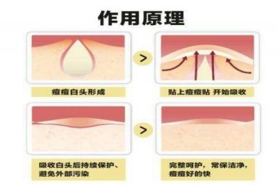 ​痘痘贴的工作原理有什么 痘痘贴应该怎么用呢